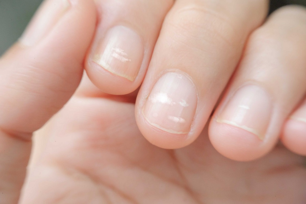 White Spots On Nails