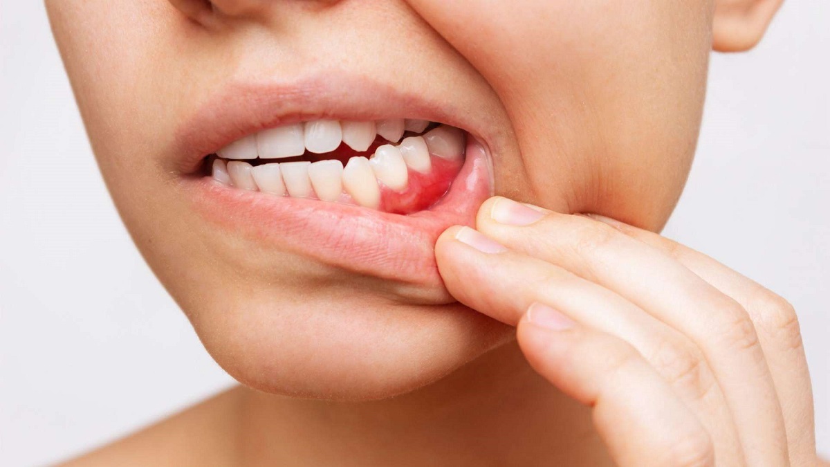 Bleeding gums and dental issues