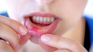 Canker Sores Home Remedies