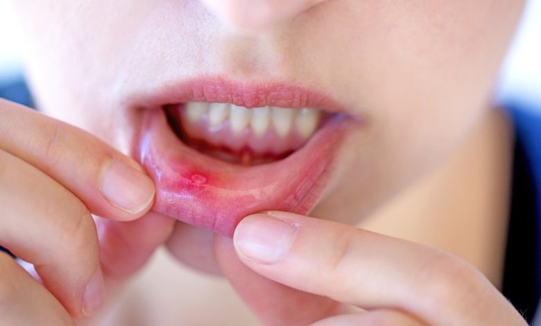 Canker Sores Home Remedies