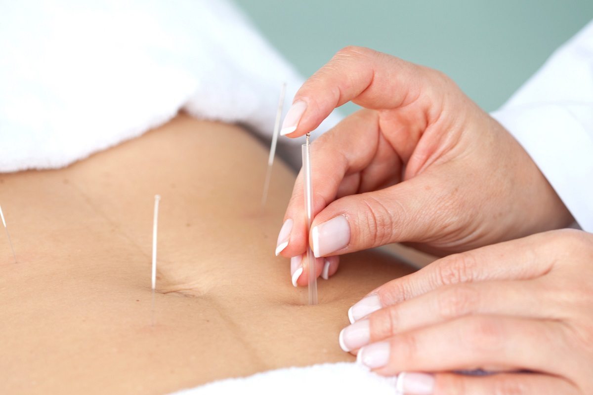 Thread Implantation And Acupuncture