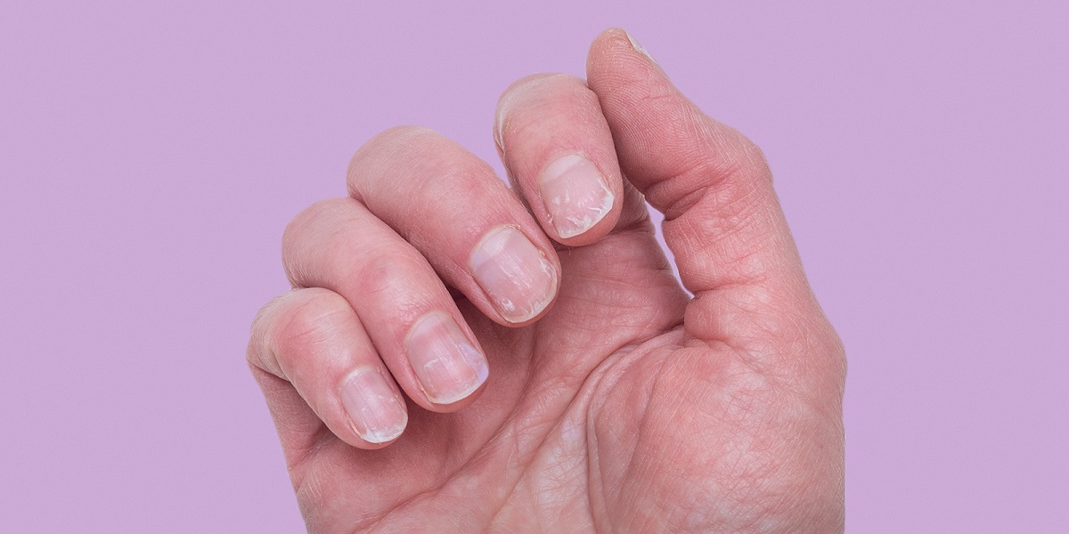 Nail State Of Health