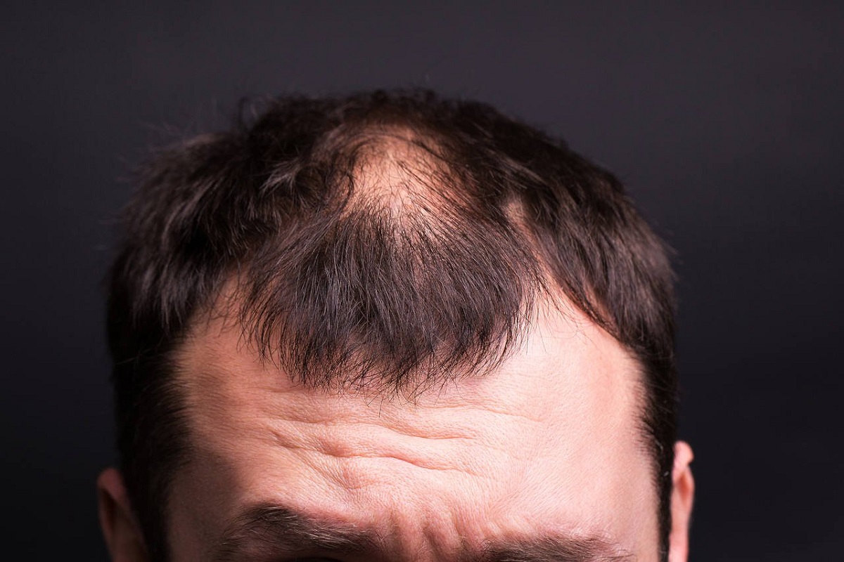 Hair Loss In Men