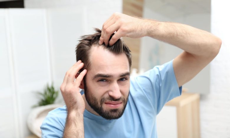 Hair Loss In Men