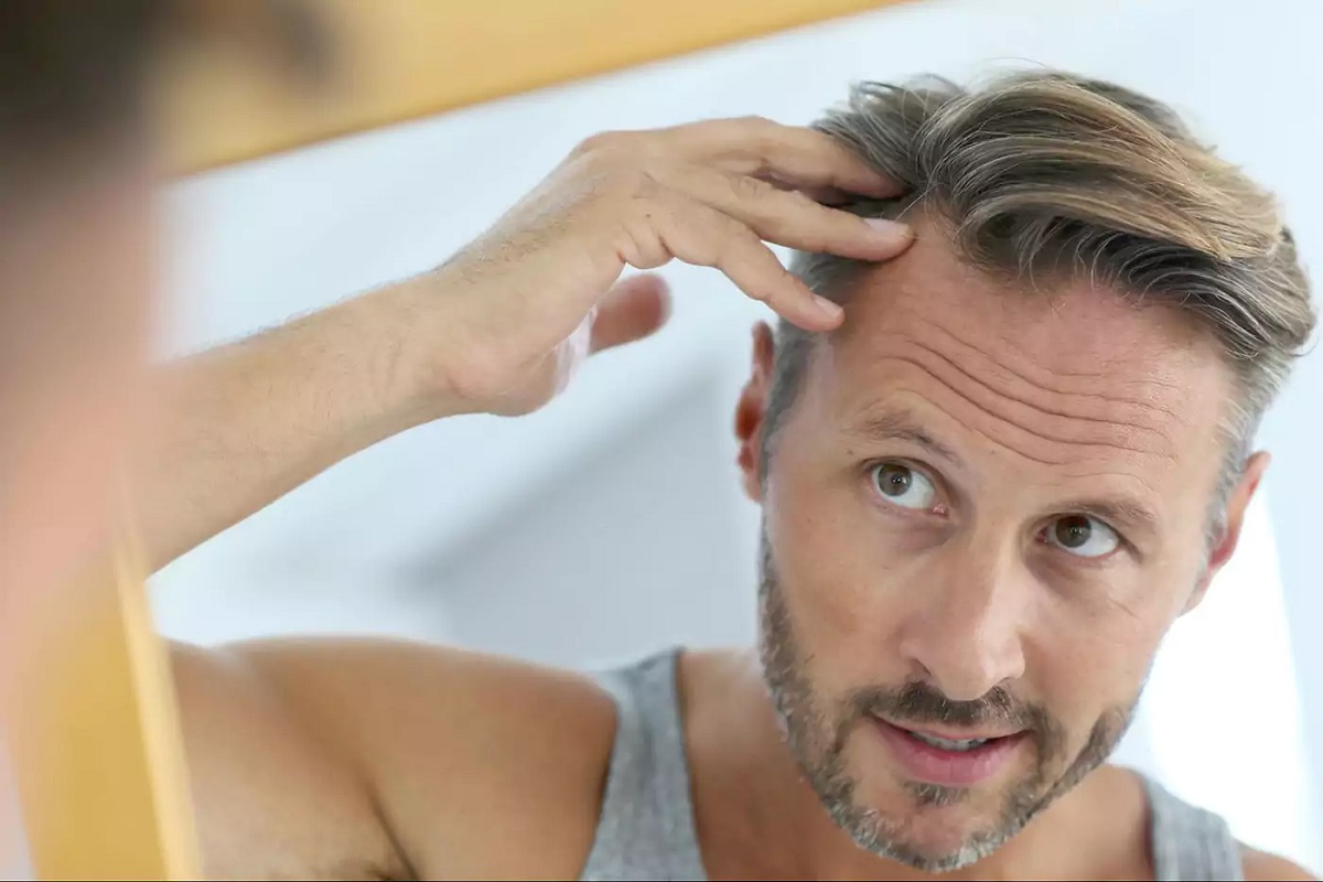 Hair Loss In Men