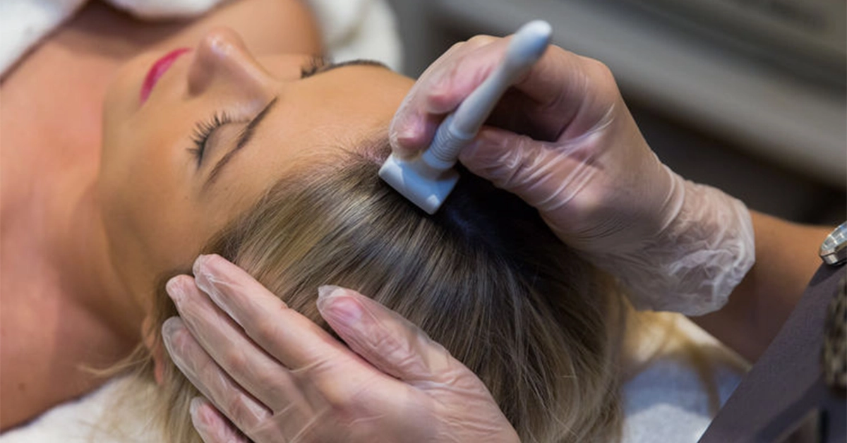 Microneedling For Hair Loss