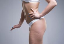 Female Cellulite Causes