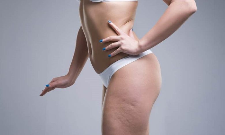 Female Cellulite Causes