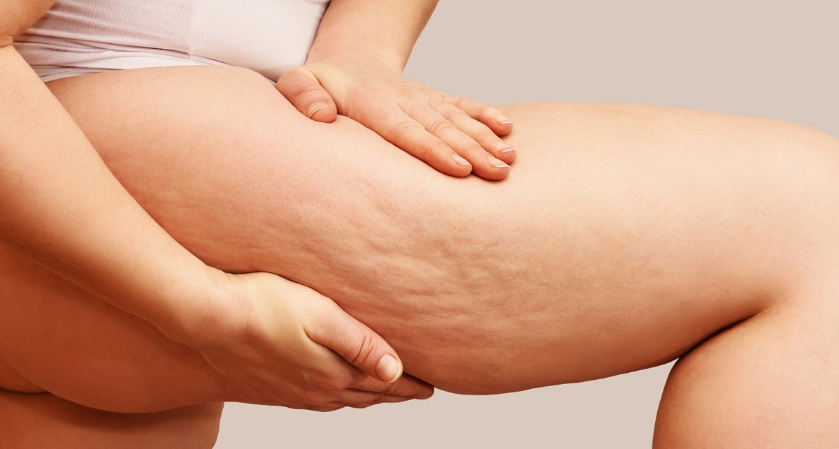 Female Cellulite Causes