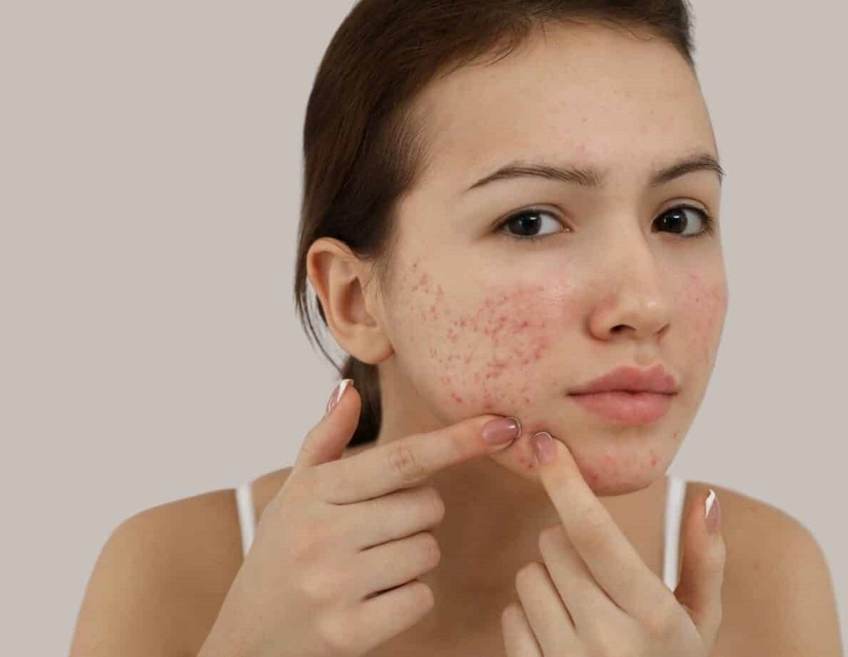 Acne Management In Teens