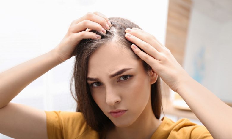 Hereditary Hair Loss