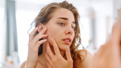 Acne Management In Teens