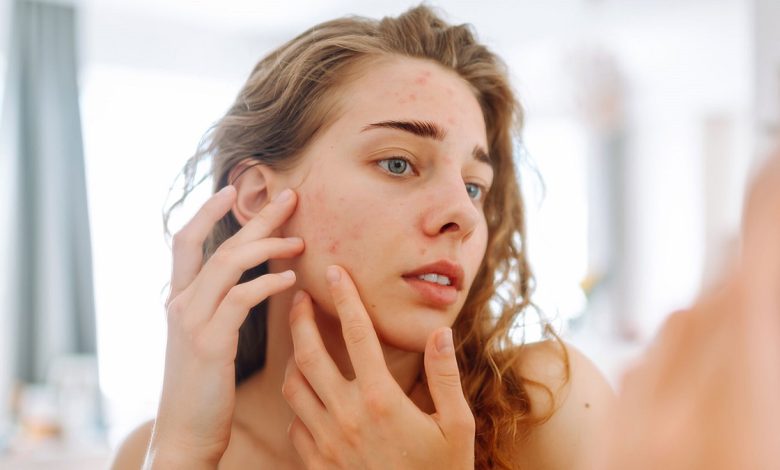 Acne Management In Teens