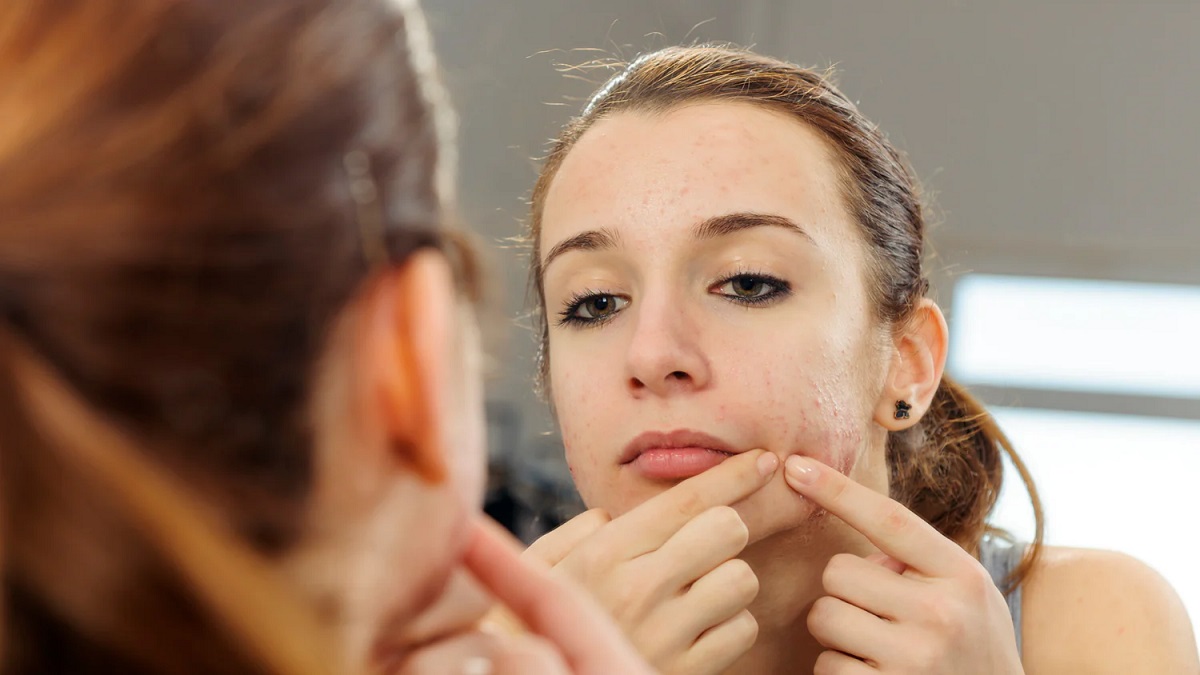 Acne Management In Teens