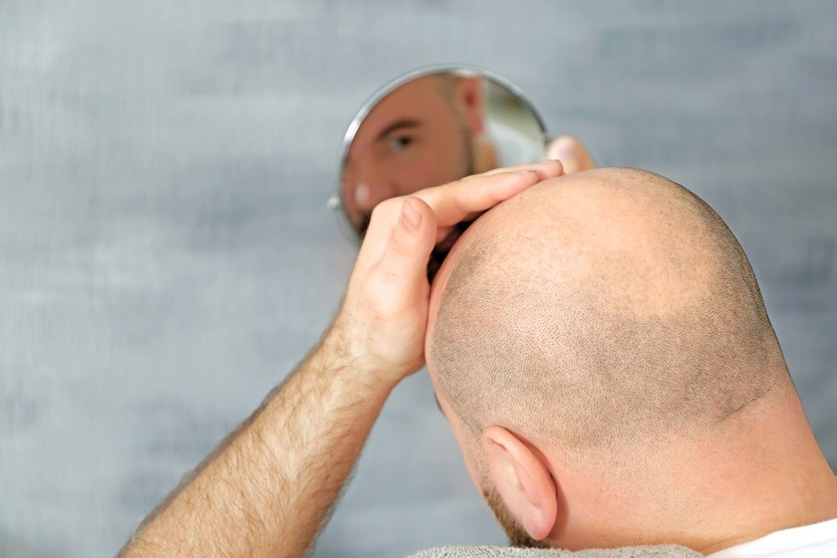 Hair Transplant