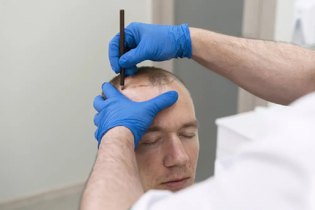 Hair Transplant