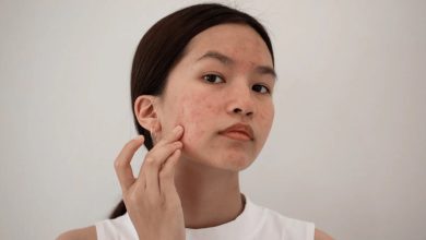 Fruits For Acne