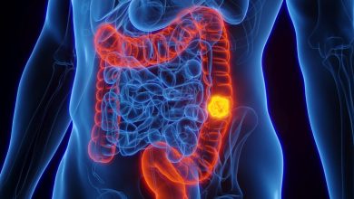 Prevent Colon Cancer