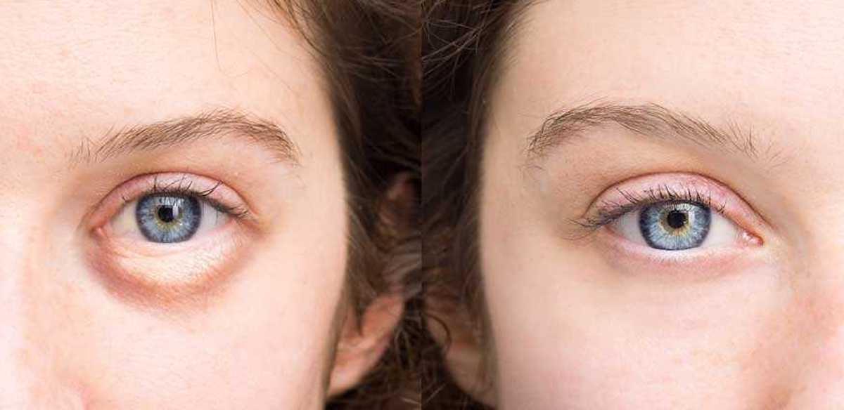 Home remedies for under-eye puffiness