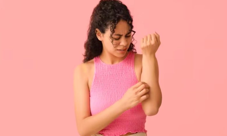 Home remedies for heat rash